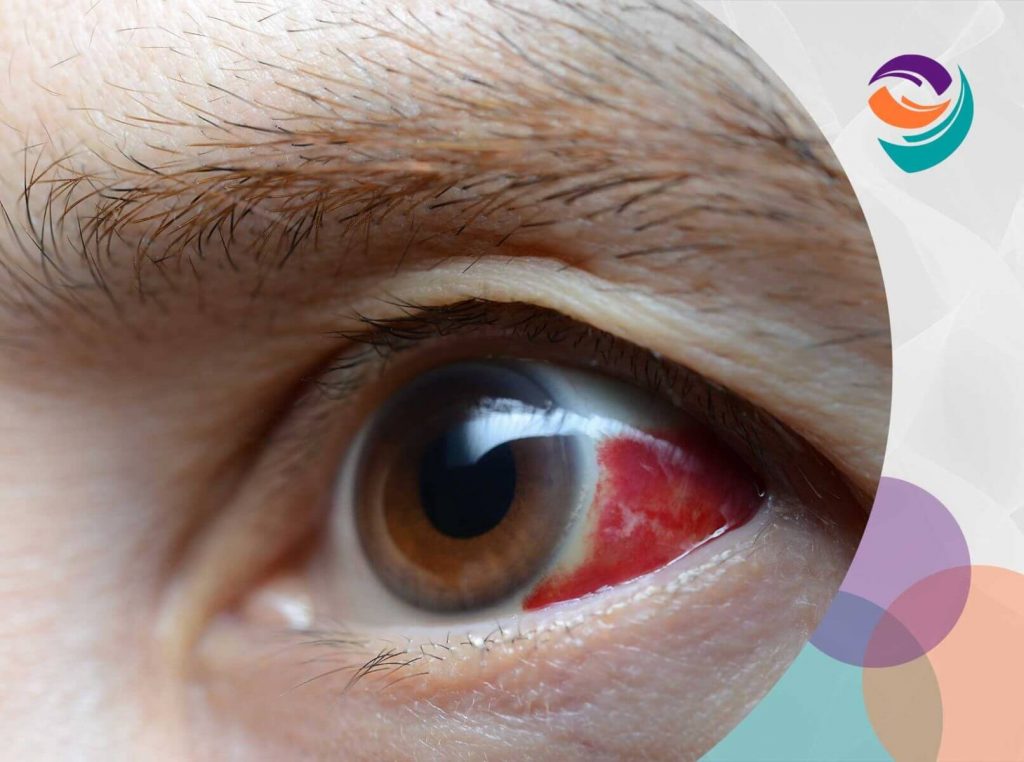 ¿Qué es la conjuntivitis? - Conoce los síntomas oculares aquí